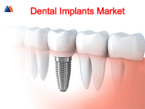 Dental Implants Market .jpg